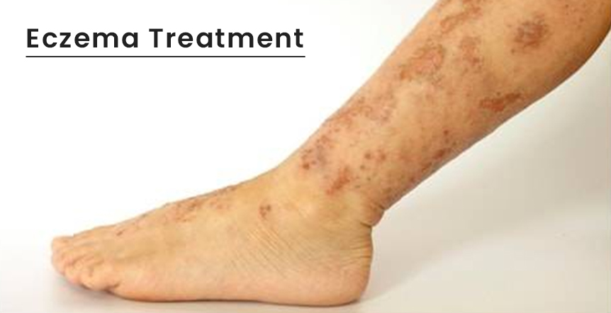 Eczema Treatment in Ahmedabad